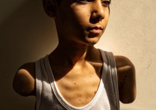 Portrait of a wounded Palestinian boy wins Press Photo of the Year